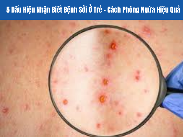 5 Dấu Hiệu Nhận Biết Bệnh Sởi Ở Trẻ